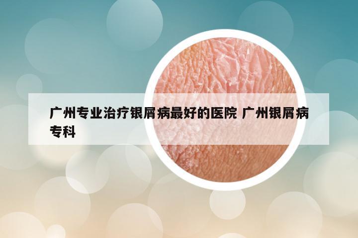 广州专业治疗银屑病最好的医院 广州银屑病专科
