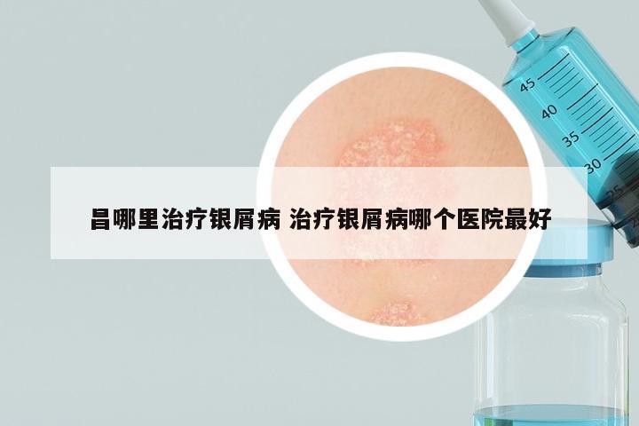 昌哪里治疗银屑病 治疗银屑病哪个医院最好
