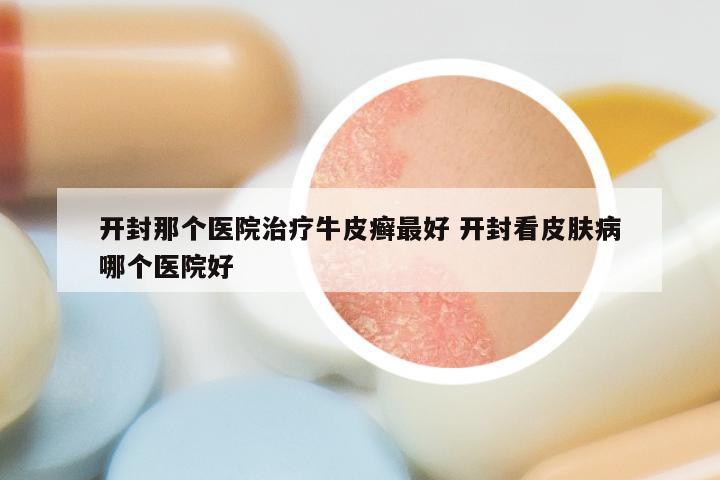 开封那个医院治疗牛皮癣最好 开封看皮肤病哪个医院好