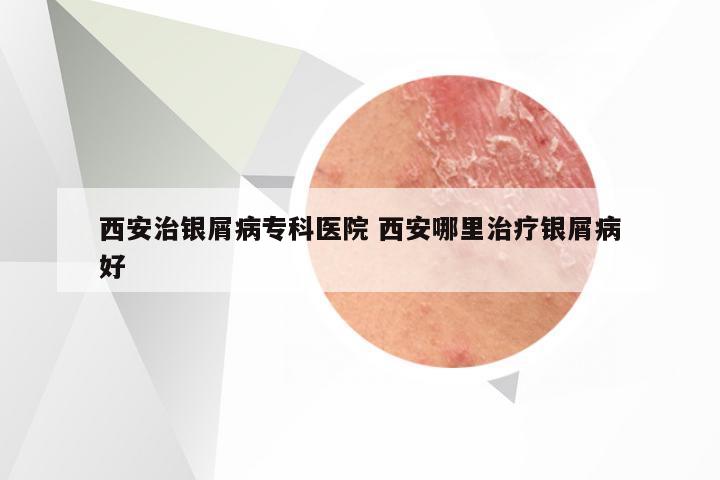 西安治银屑病专科医院 西安哪里治疗银屑病好
