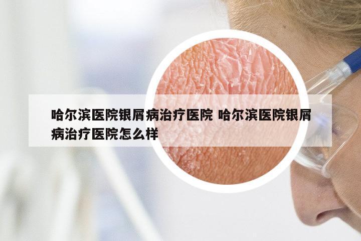 哈尔滨医院银屑病治疗医院 哈尔滨医院银屑病治疗医院怎么样