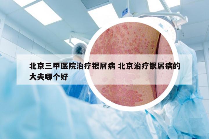 北京三甲医院治疗银屑病 北京治疗银屑病的大夫哪个好