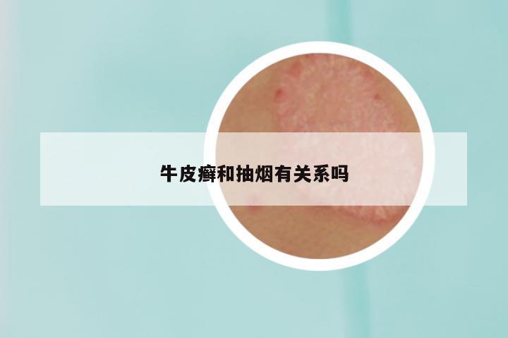 牛皮癣和抽烟有关系吗