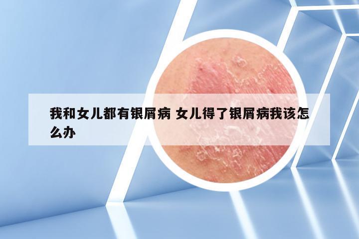 我和女儿都有银屑病 女儿得了银屑病我该怎么办