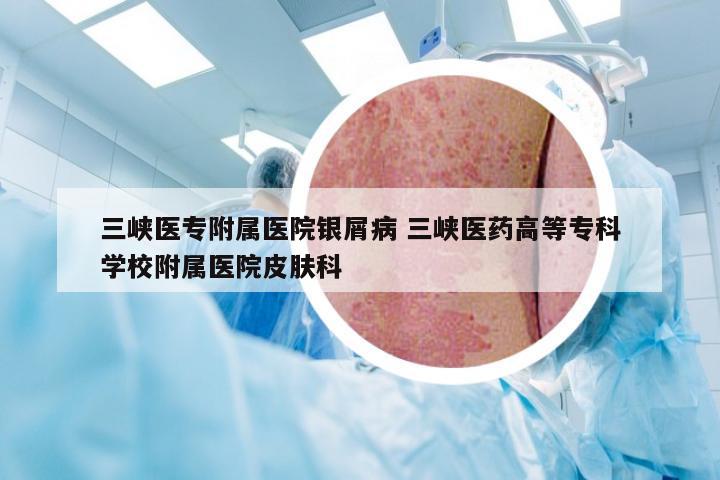 三峡医专附属医院银屑病 三峡医药高等专科学校附属医院皮肤科