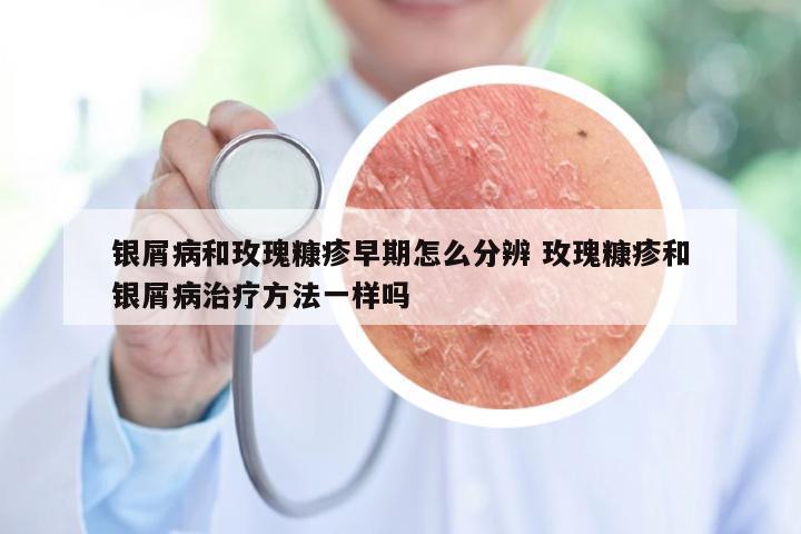 银屑病和玫瑰糠疹早期怎么分辨 玫瑰糠疹和银屑病治疗方法一样吗
