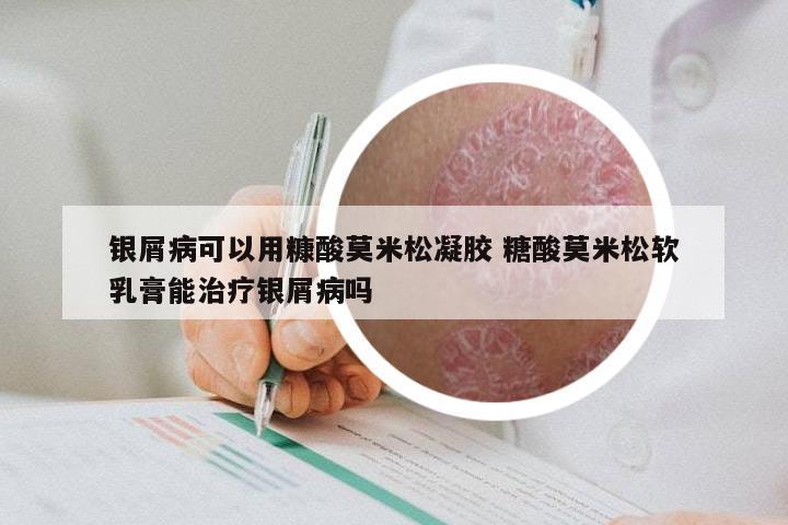 银屑病可以用糠酸莫米松凝胶 糖酸莫米松软乳膏能治疗银屑病吗