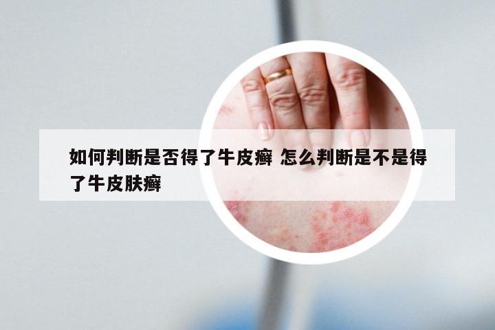 如何判断是否得了牛皮癣 怎么判断是不是得了牛皮肤癣