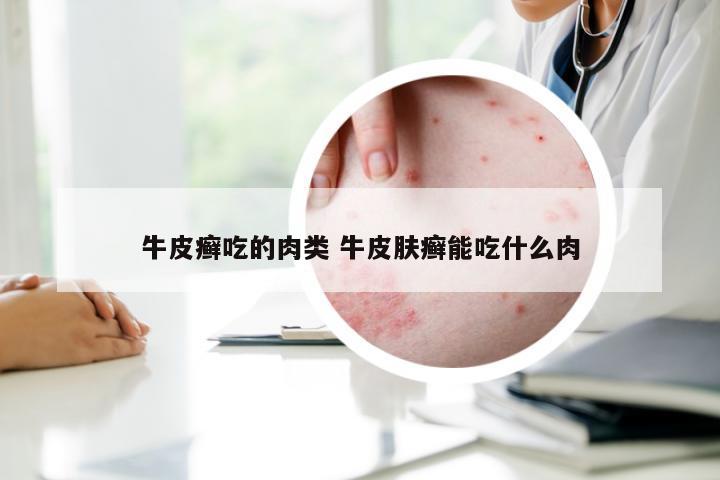 牛皮癣吃的肉类 牛皮肤癣能吃什么肉