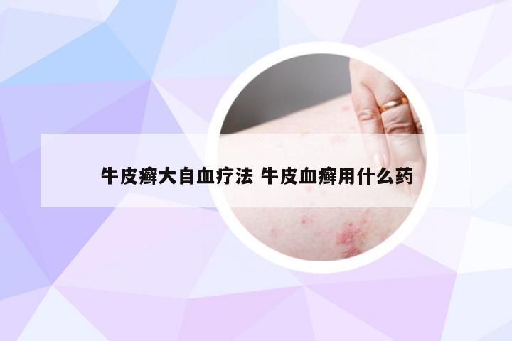 牛皮癣大自血疗法 牛皮血癣用什么药