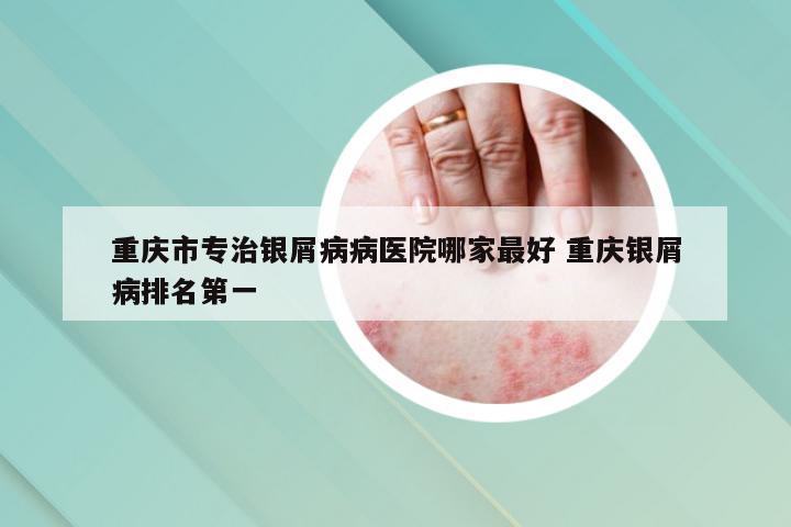 重庆市专治银屑病病医院哪家最好 重庆银屑病排名第一