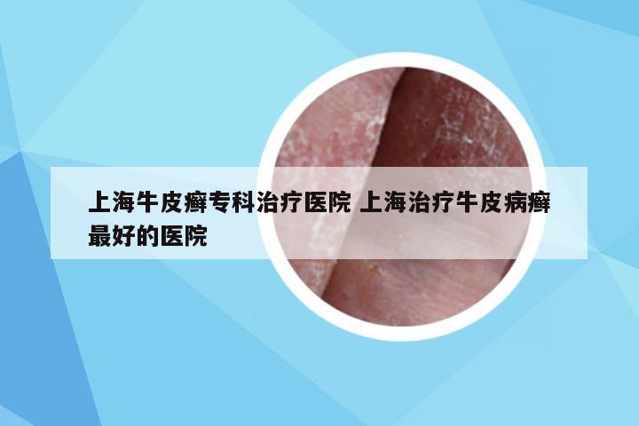 上海牛皮癣专科治疗医院 上海治疗牛皮病癣最好的医院