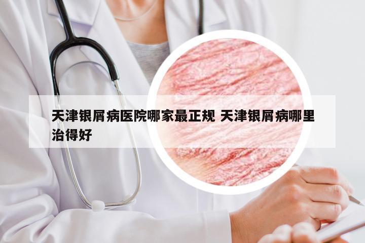 天津银屑病医院哪家最正规 天津银屑病哪里治得好