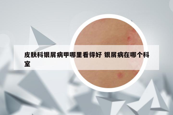 皮肤科银屑病甲哪里看得好 银屑病在哪个科室