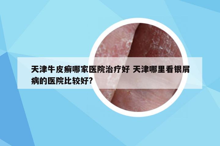天津牛皮癣哪家医院治疗好 天津哪里看银屑病的医院比较好?