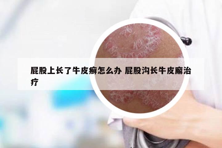 屁股上长了牛皮癣怎么办 屁股沟长牛皮廨治疗