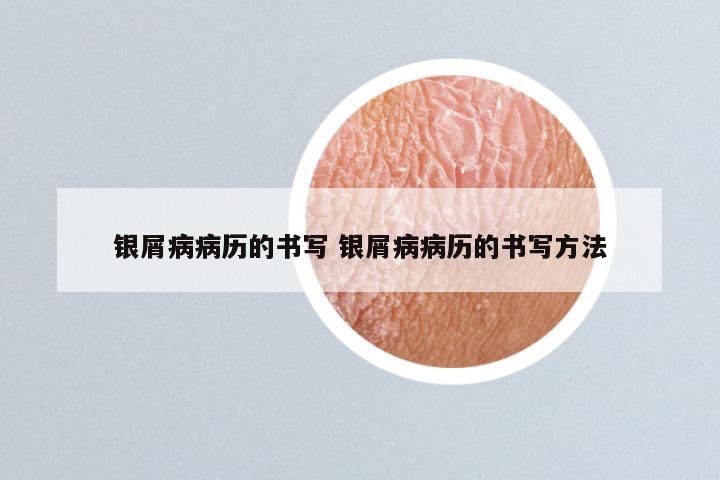 银屑病病历的书写 银屑病病历的书写方法