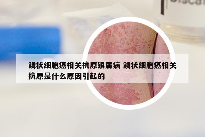 鳞状细胞癌相关抗原银屑病 鳞状细胞癌相关抗原是什么原因引起的