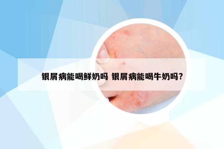 银屑病能喝鲜奶吗 银屑病能喝牛奶吗?