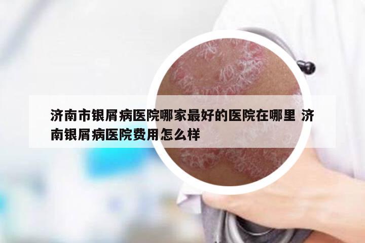 济南市银屑病医院哪家最好的医院在哪里 济南银屑病医院费用怎么样