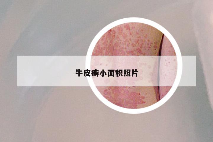 牛皮癣小面积照片