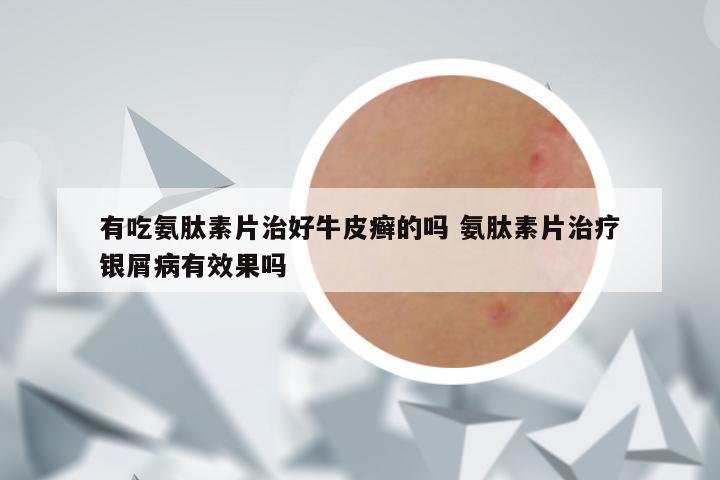 有吃氨肽素片治好牛皮癣的吗 氨肽素片治疗银屑病有效果吗