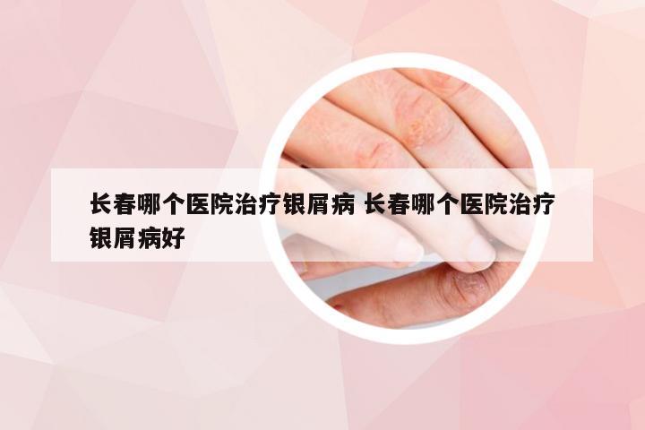 长春哪个医院治疗银屑病 长春哪个医院治疗银屑病好