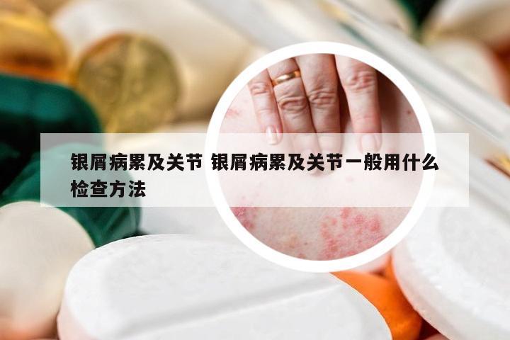 银屑病累及关节 银屑病累及关节一般用什么检查方法