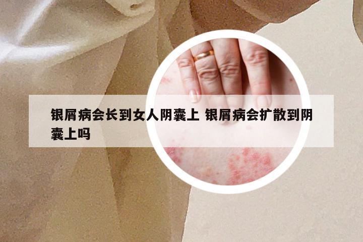 银屑病会长到女人阴囊上 银屑病会扩散到阴囊上吗