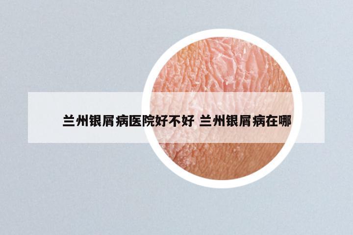 兰州银屑病医院好不好 兰州银屑病在哪