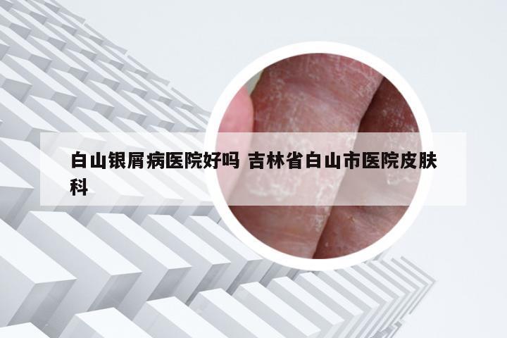 白山银屑病医院好吗 吉林省白山市医院皮肤科