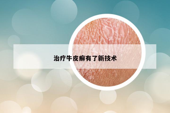 治疗牛皮癣有了新技术