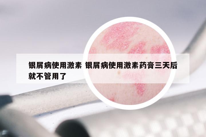 银屑病使用激素 银屑病使用激素药膏三天后就不管用了