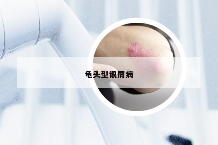 龟头型银屑病