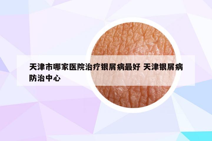 天津市哪家医院治疗银屑病最好 天津银屑病防治中心