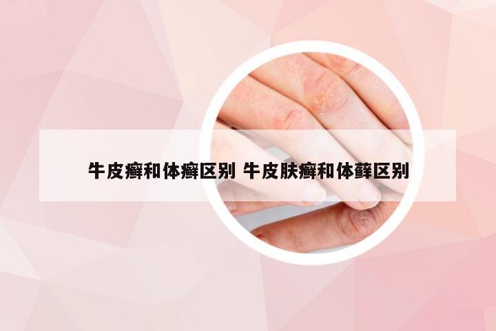 牛皮癣和体癣区别 牛皮肤癣和体藓区别