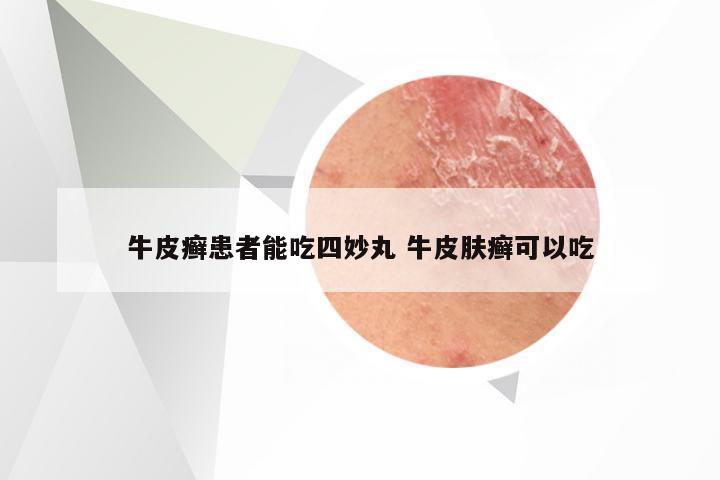 牛皮癣患者能吃四妙丸 牛皮肤癣可以吃