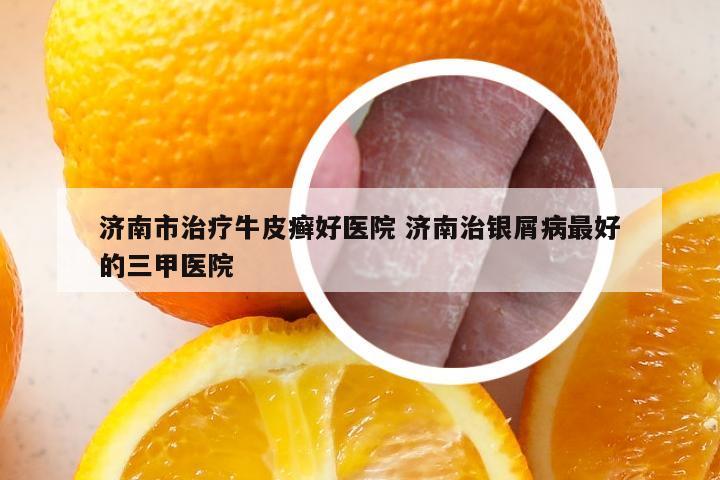 济南市治疗牛皮癣好医院 济南治银屑病最好的三甲医院