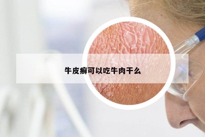牛皮癣可以吃牛肉干么