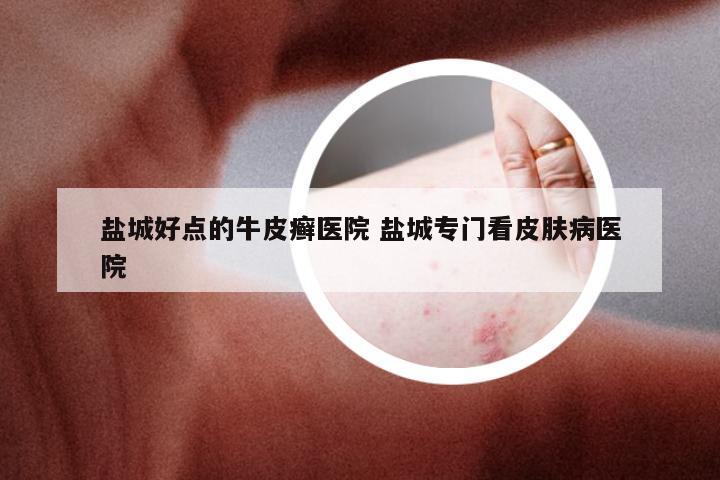 盐城好点的牛皮癣医院 盐城专门看皮肤病医院