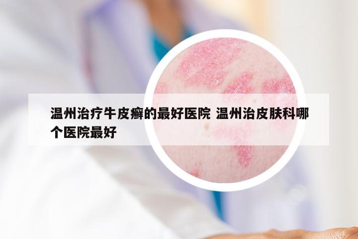 温州治疗牛皮癣的最好医院 温州治皮肤科哪个医院最好