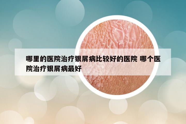 哪里的医院治疗银屑病比较好的医院 哪个医院治疗银屑病最好