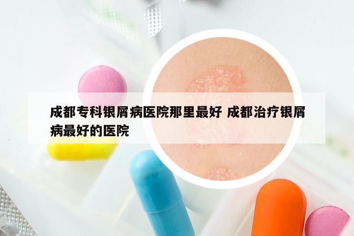成都专科银屑病医院那里最好 成都治疗银屑病最好的医院