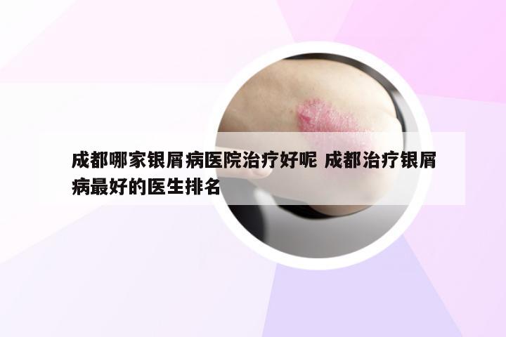 成都哪家银屑病医院治疗好呢 成都治疗银屑病最好的医生排名