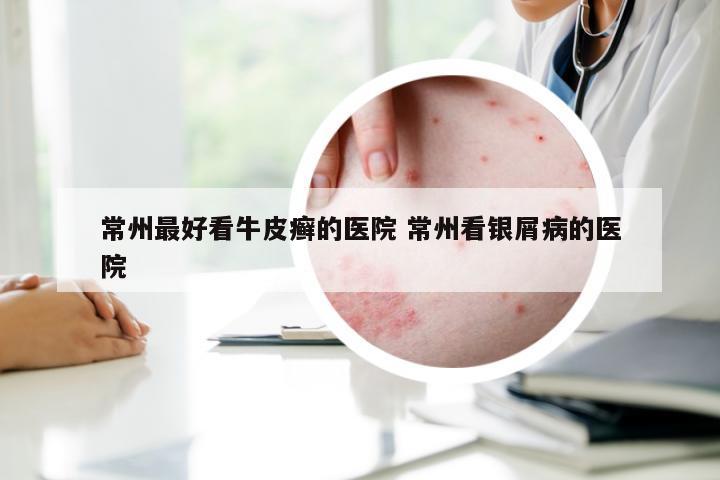 常州最好看牛皮癣的医院 常州看银屑病的医院