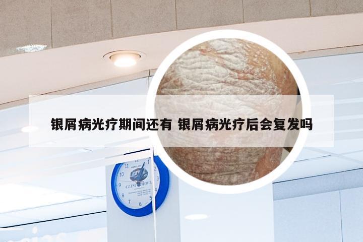 银屑病光疗期间还有 银屑病光疗后会复发吗