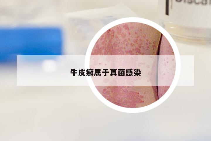 牛皮癣属于真菌感染