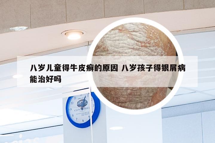 八岁儿童得牛皮癣的原因 八岁孩子得银屑病能治好吗