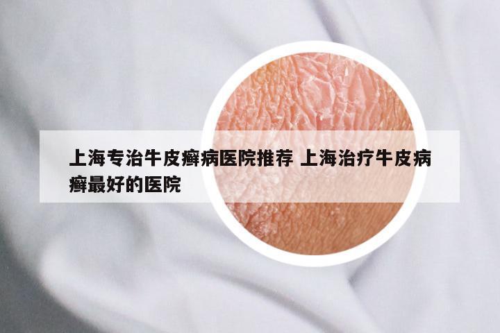 上海专治牛皮癣病医院推荐 上海治疗牛皮病癣最好的医院