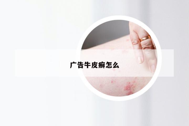广告牛皮癣怎么